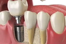 El 24% de las personas con implantes dentales desarrolla periimplantitis - Foto