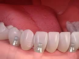 Implantes dentales: qu molestias son normales y cules no tras un tratamiento? - Foto