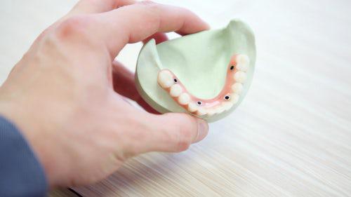 Implantes dentales o prtesis dentales? - Foto