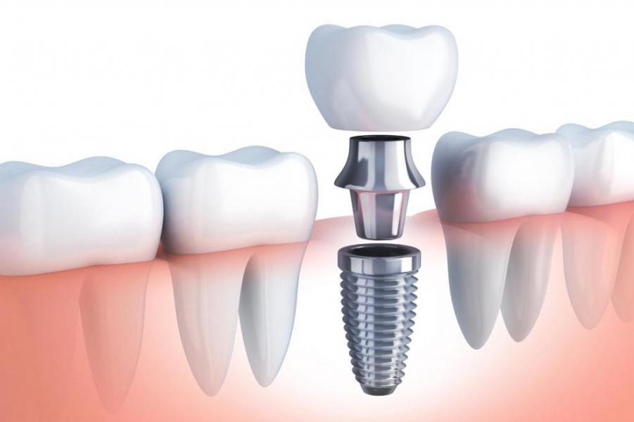 Proceso de un tratamiento de implantologa dental - Foto