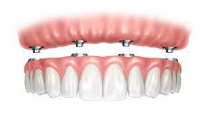 Implantes dentales para toda la vida? - Foto