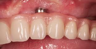 Por qu fracasa un tratamiento de implantes dentales?  - Foto