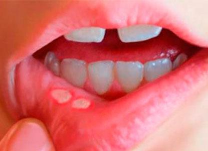 Qu es la estomatitis? - Foto