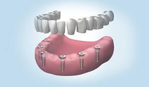 Preguntas frecuentes sobre implantes dentales - Foto