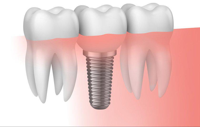 Tres aspectos a tener presentes antes de la colocacin de implantes dentales - Foto