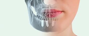 Implantes dentales definitivos: en qu consiste este tratamiento? - Foto 2